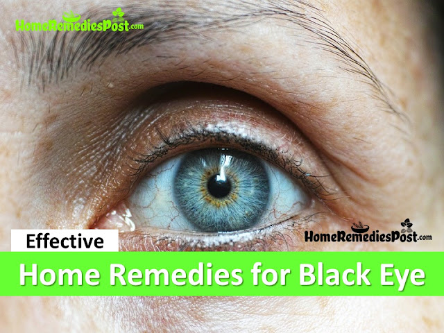how to get rid of black eye, home remedies for black eye, how to treat black eye fast, black eye treatment, black eye fast relief, black eye home remedies, how to cure black eye, black eye remedies, remedies for black eye, cure black eye, treatment for black eye, best black eye treatment, how to get relief from black eye, relief from black eye, 