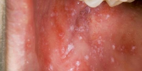 Brown Spots In Mouth 29