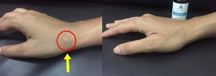 Cara Hilangkan Parut Di Badan Dengan Berkesan