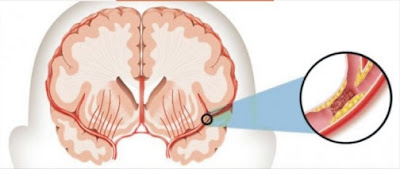 Stroke Iskemik Pembuluh darah tersumbat di bagian otak sehingga menyebabkan stroke iskemik