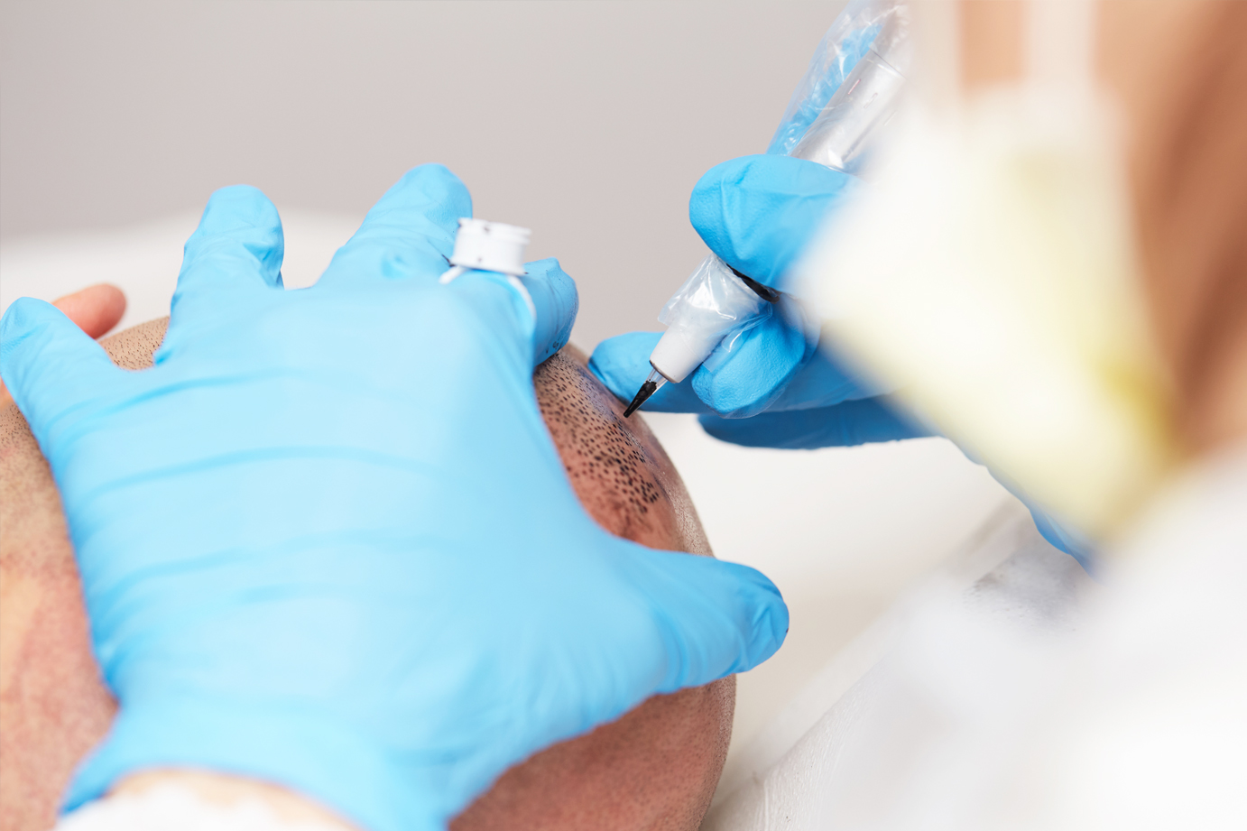 Scalp Micropigmentation Toronto