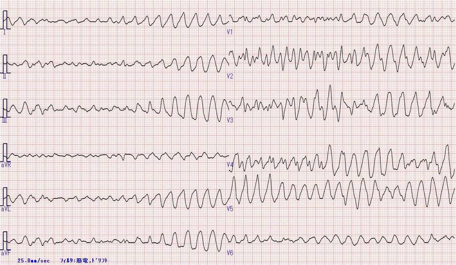 松下 Er ランチ カンファレンス 心電図 Vt Vf