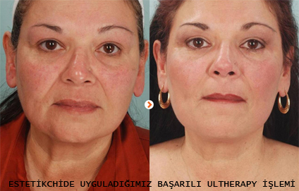 Izmir Botox Dolgu Medikal Estetik Urun Satisi 90 534 965 34 00 Ameliyatsiz Yuz Germe