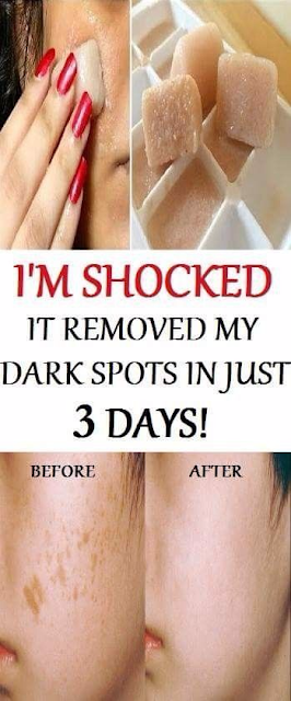 I’m SHOCKED It Removed My Dark Spots In 3 Days, Magic Remedy