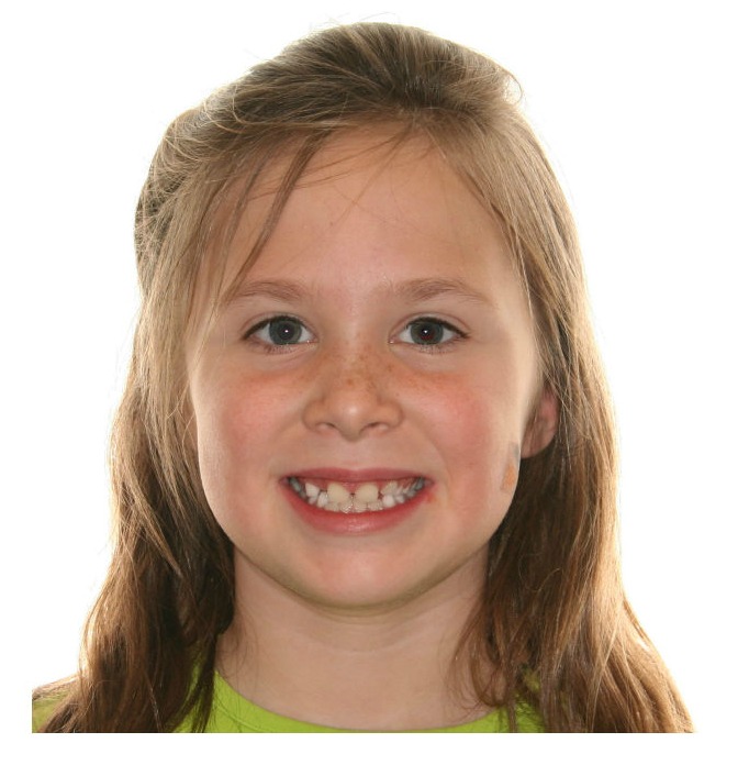 St Clair Orthodontics, Damon braces, Invisalign: Before and After: Abby