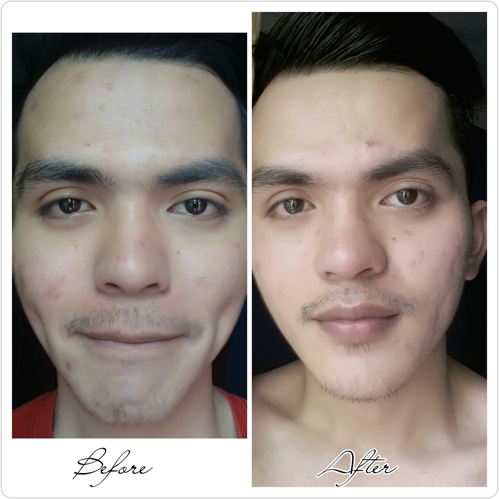 Get Rid of Pimples Using Celeteque Brightening Facial Wash Vanity