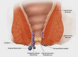 wasir obat herbal wasir