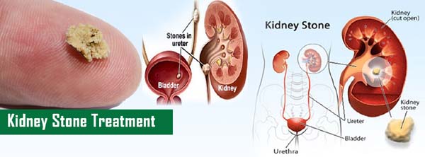 Top Kidney disease Treatment by Expert homeopathy doctor Delhi India