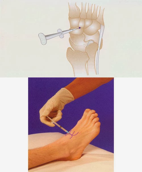Midar Injection Midtarsal Joint Injection ~ Nursing