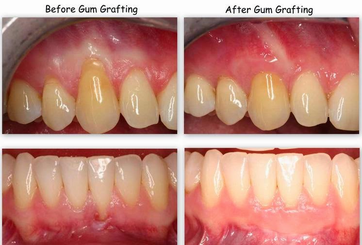 Omni Dental Group Gingival Grafts