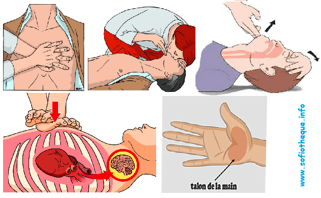 Prise en charge [Massage cardiaque externe] face à une personne en Arrêt Cardio-Respiratoire