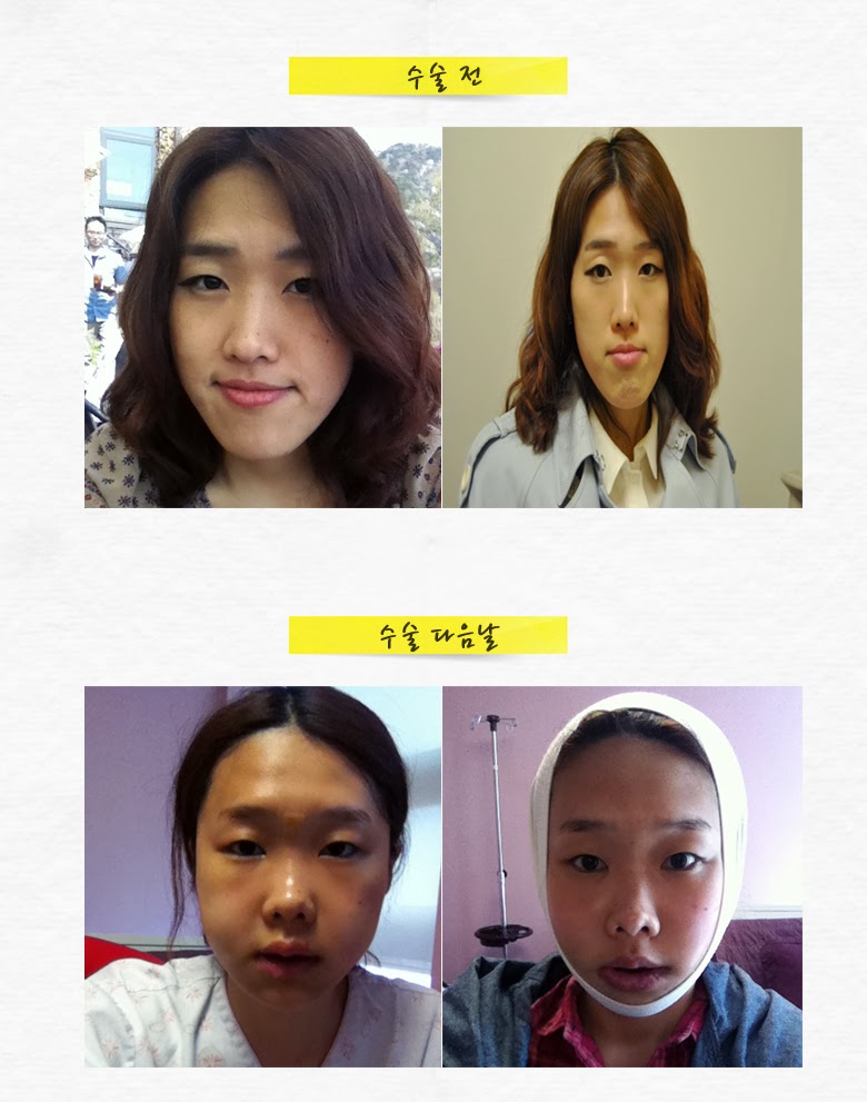 ID Hospital Korea How Much Is Korea Plastic Surgery Two Jaw Surgery id-hospital-korea-how-much-is-korea-plastic-surgery-two-jaw-surgery