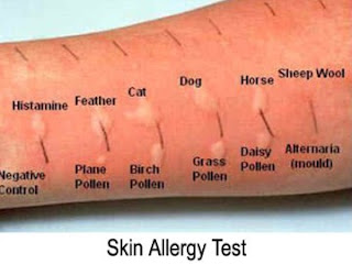 एलर्जी टेस्ट, एलर्जी कारण लक्षण एवं उपचार, नाक की एलर्जी का इलाज, एलर्जी टेस्ट कॉस्ट, गले की एलर्जी, एलर्जी की दवा, allergy blood test, एलर्जी के कारण, allergy test in hindi