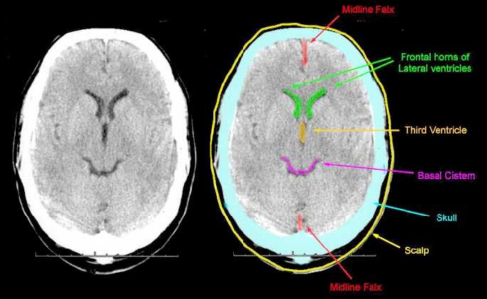 Цистерны мозга расширены. Базальные цистерны головного мозга кт анатомия. Базальные цистерны головного мозга кт. Кт головного мозга аксиальный срез. Цистерны головного мозга на кт анатомия.
