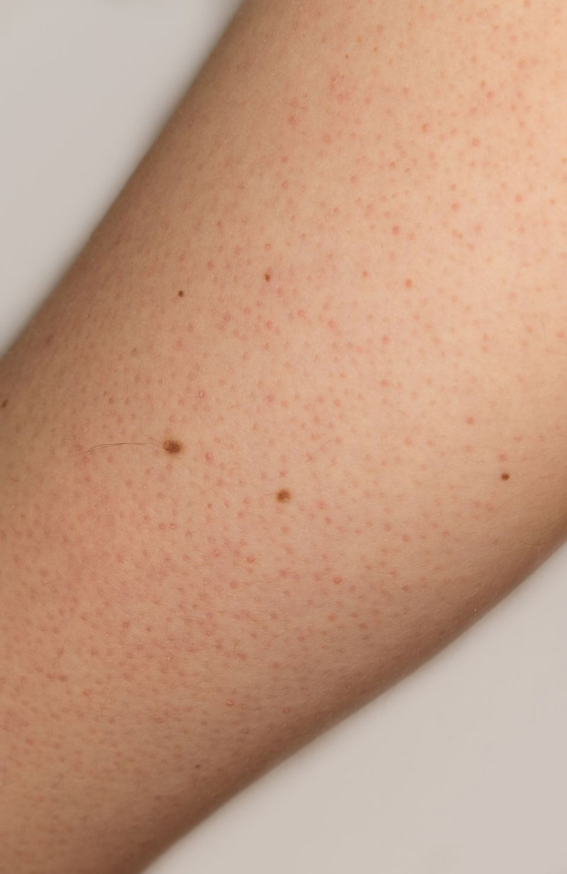 keratosis pilaris 1177