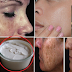 Remove Dark Spot With The Help Of Effective Simple Natural Remedy