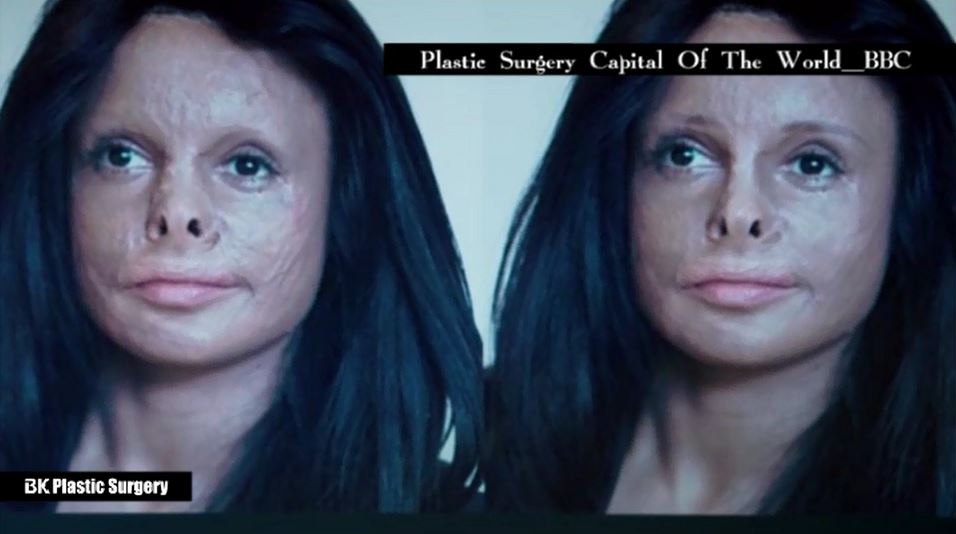BK HospitalPlastic Surgery [UK BBC Documentary] BK Plastic Surgery