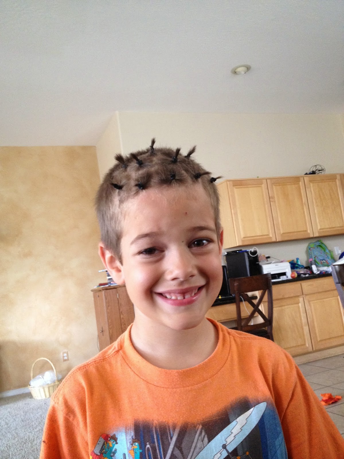 Congential Ptosis and Frontalis Sling Surgery