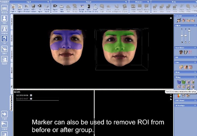DENTAL SOFTWARE: Using new ROI marker tools in Planmeca Romexis® ProFace&Surface module
