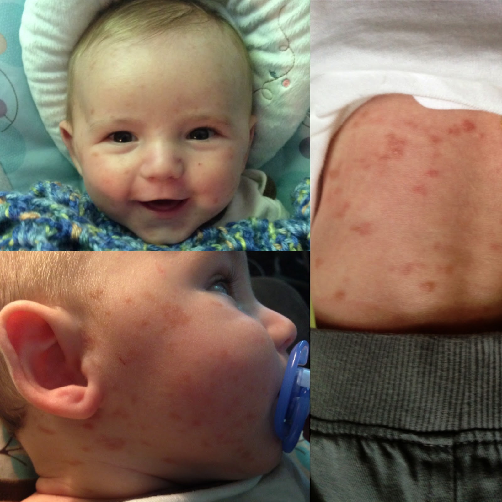 GreenLeeaves Mastocytosis