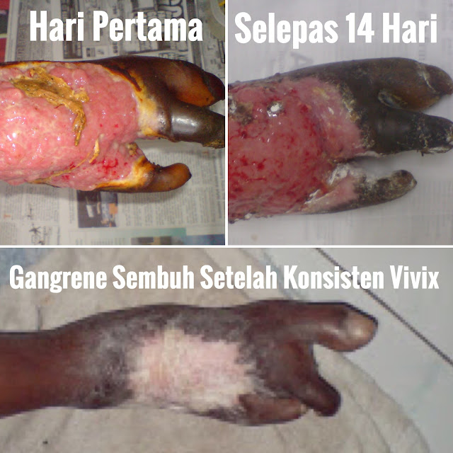 ubat untuk gangrene, merawat gangren, cara merawat gangrene, merawat luka gangrene, rawat luka kencing manis, ubat rawat luka kencing manis