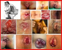 obat tradisional wasir parah,obat ambeien paling ampuh di apotik,obat tradisional wasir parah,obat ambeien paling ampuh di apotik,obat alami ambeien yang sudah parah,obat tradisional ambeien paling ampuh obat tradisional wasir parah,obat ambeien paling ampuh di apotik,obat tradisional wasir parah,obat ambeien paling ampuh di apotik,obat alami ambeien yang sudah parah,obat tradisional ambeien paling ampuh