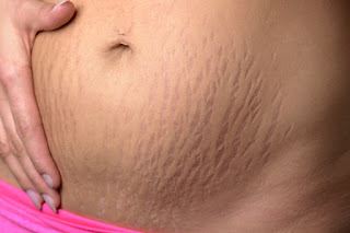 Cara Cepat Menghilangkan Stretch Mark / Selulit Secara Alami Cara Cepat Menghilangkan Stretch Mark / Selulit Secara Alami