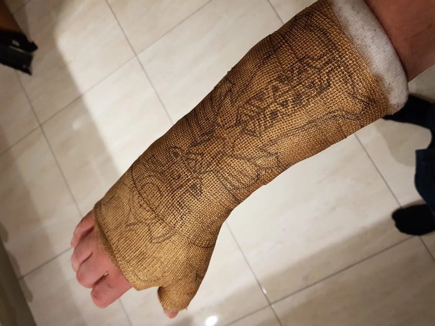 After This Guy Broke His Wrist, He Decided To Transform His Cast Into