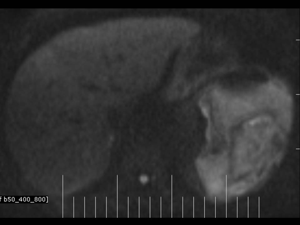 Radshare SPLENIC ABSCESS