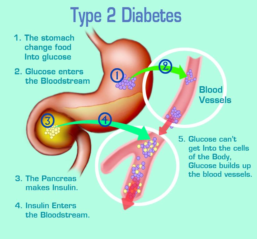 Diagnose Diabetes Insipidus Diagnose