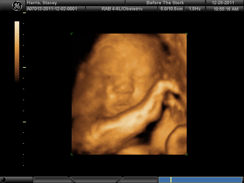 . 32 Week 3D Ultrasound