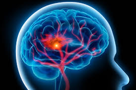 Bagaimana Cara Alami Mengatasi Penyakit Stroke?, apa gejala awal penyakit stroke ringan?, bagaimana cara ampuh mengobati stroke masih ringan?