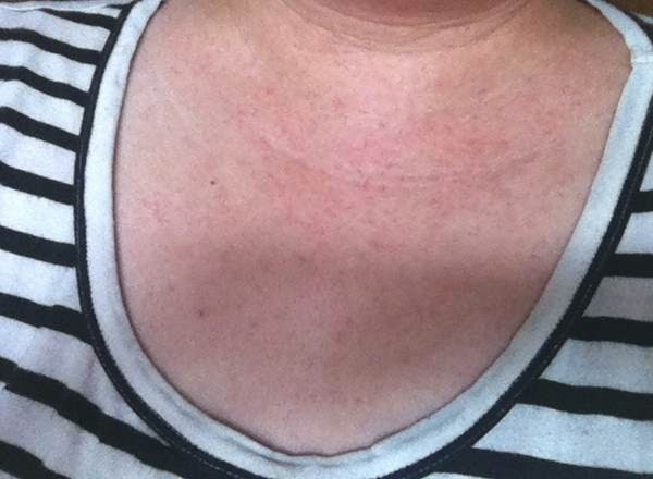 Faith Luv 2 Eat N Travel : My Week With Rashes (Viral Infection)