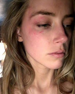 Johnny Depp Wife Beater, Amber Heard beaten, Amber Heard black eye