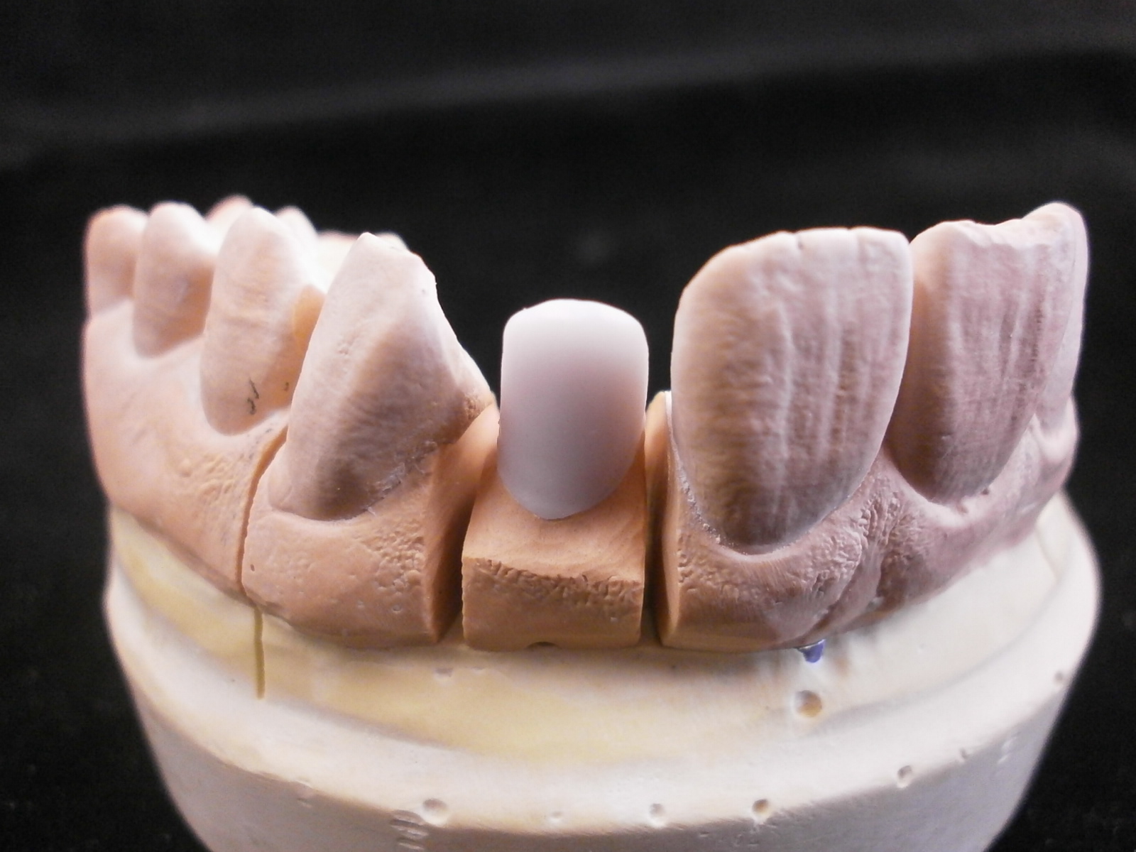 髙田朝（Hajime Takada）のオーダーメイド歯科技工物の紹介 Introduction of custommade dental