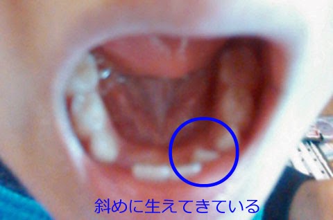 Nobuyuki Oshima 6歳児の歯 前歯の乳歯は抜けて 横の永久歯は斜めに生えてきた