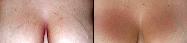 Mejora de calidad de la piel del escote con Biodermogenesi( Bi-One)