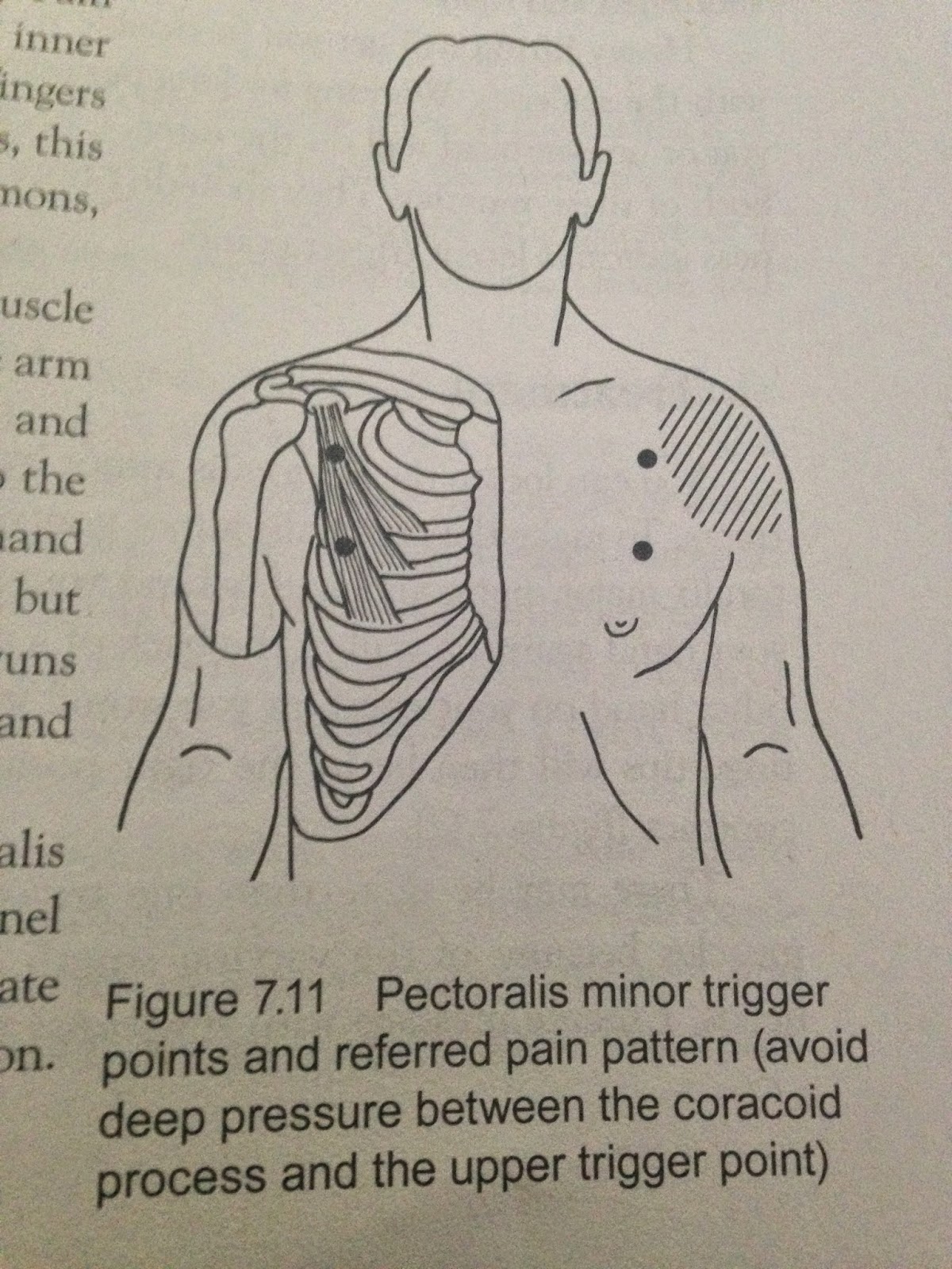 Trigger Point Work For: Psoas, Minor Pecs, Lower Calves, Lower Back ...
