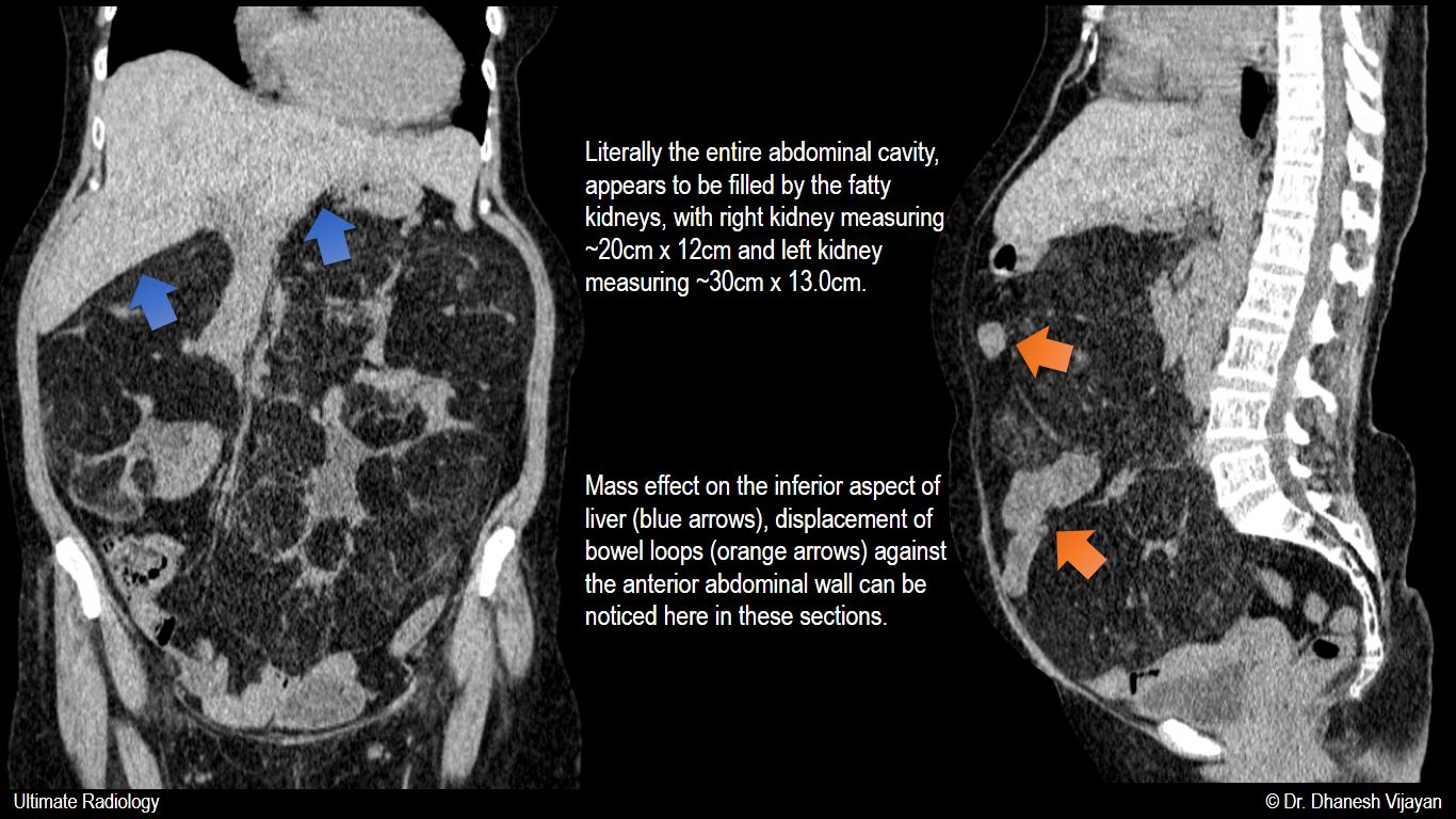 Ultimate Radiology RARE Extreme case of bilateral massive renal