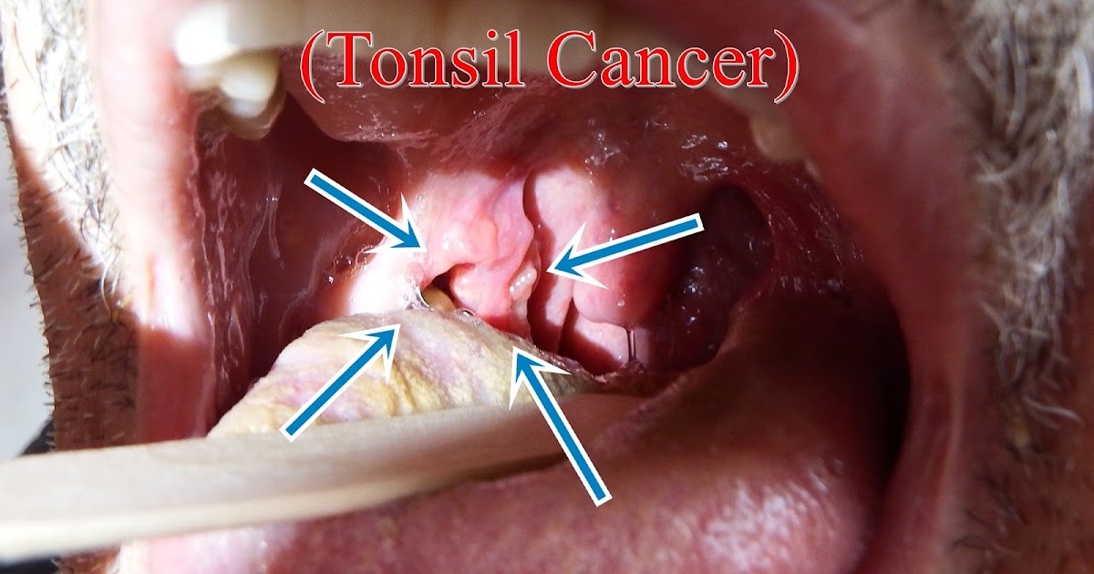 lingual tonsil cancer symptoms