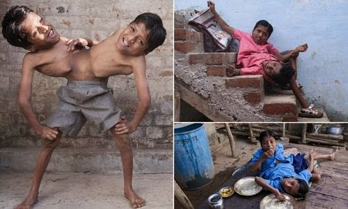 Amazing Indian Conjoined Twins : They Don