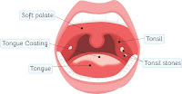 Tonsil (amandel) Tonsil (amandel)