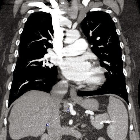 Pryce type I. pulmonary sequestration = Isolated systemic arterial supply to normal lung (ISSNL)