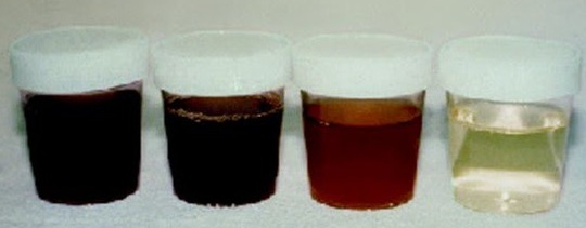 Doença da " Urina preta " Bahia e Ceará - Causas : Haff,Parechovírus,Bactérias,Toxinas,Peixe,Venenos Naturais ?!