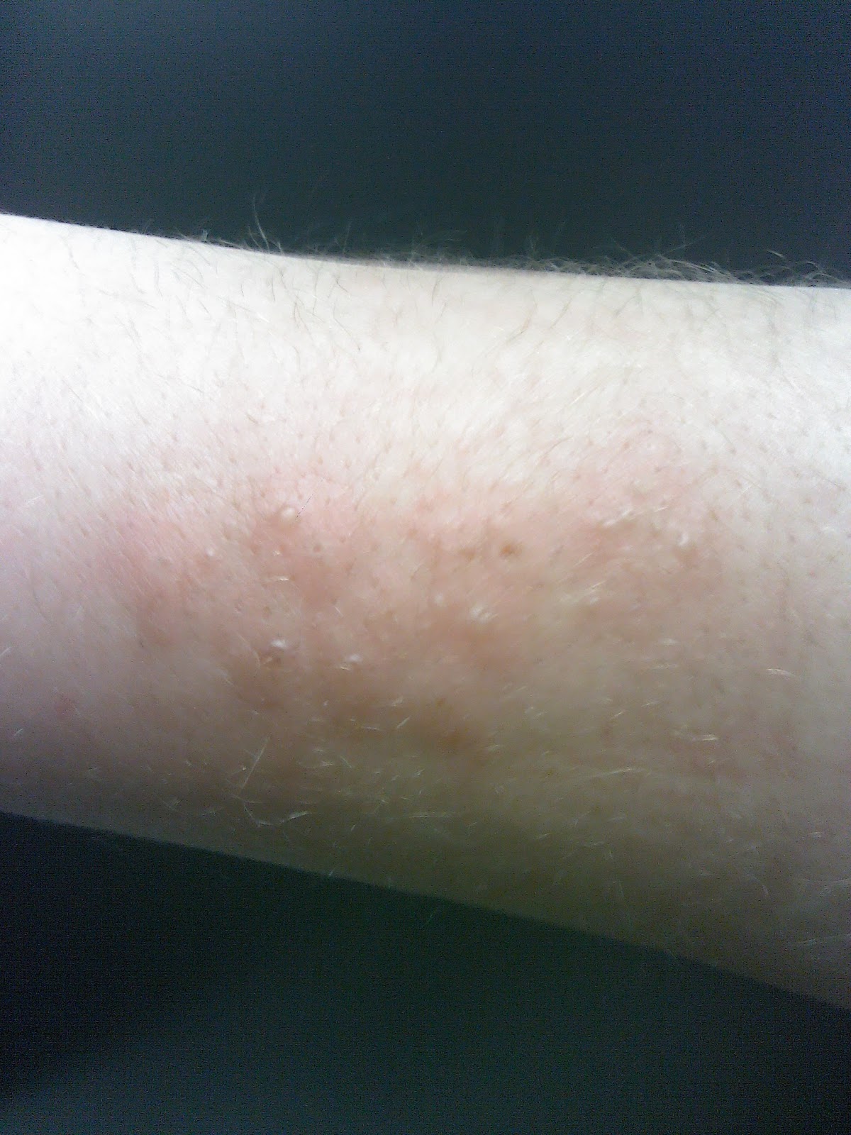 [thewheelchair]: Shingles on the Roof