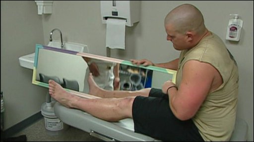 Ампутация ноги фантомные боли. Зеркало для реабилитации после инсульта. Зеркальная терапия. Зеркальная терапия после инсульта.