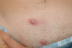 Boil in Pubic area - Dermatology - MedHelp