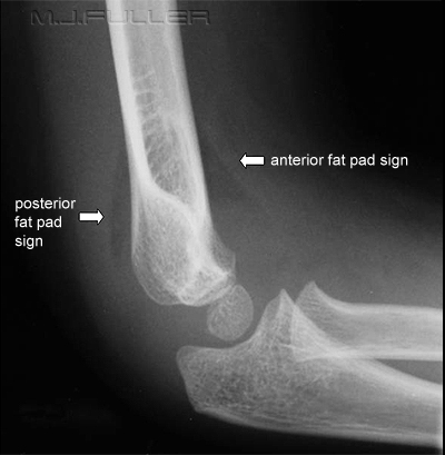 Struggling HO: Ortho: Elbow