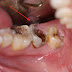 Nguyên nhân sâu răng sau khi niềng răng 