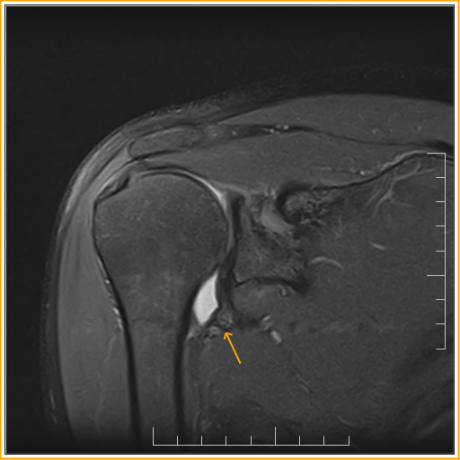 Adhesive Capsulitis MRI Sumer's Radiology Blog